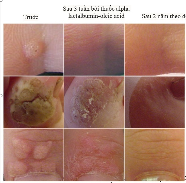Hình ảnh u nhú ở người do HPV sau 3 tuần bôi Alpha lactalbumin-oleic acid và tỉ lệ tái phát dưới 2% sau 2 năm. Ảnh: Nhóm nghiên cứu